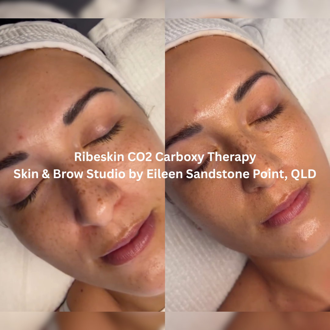 Before and after Ribeskin CO2 Carboxy Therapy at Skin & Brow Studio by Eileen, Sandstone Point QLD, showing a more radiant complexion with smoother-looking skin, improved luminosity and a hydrated appearance.
