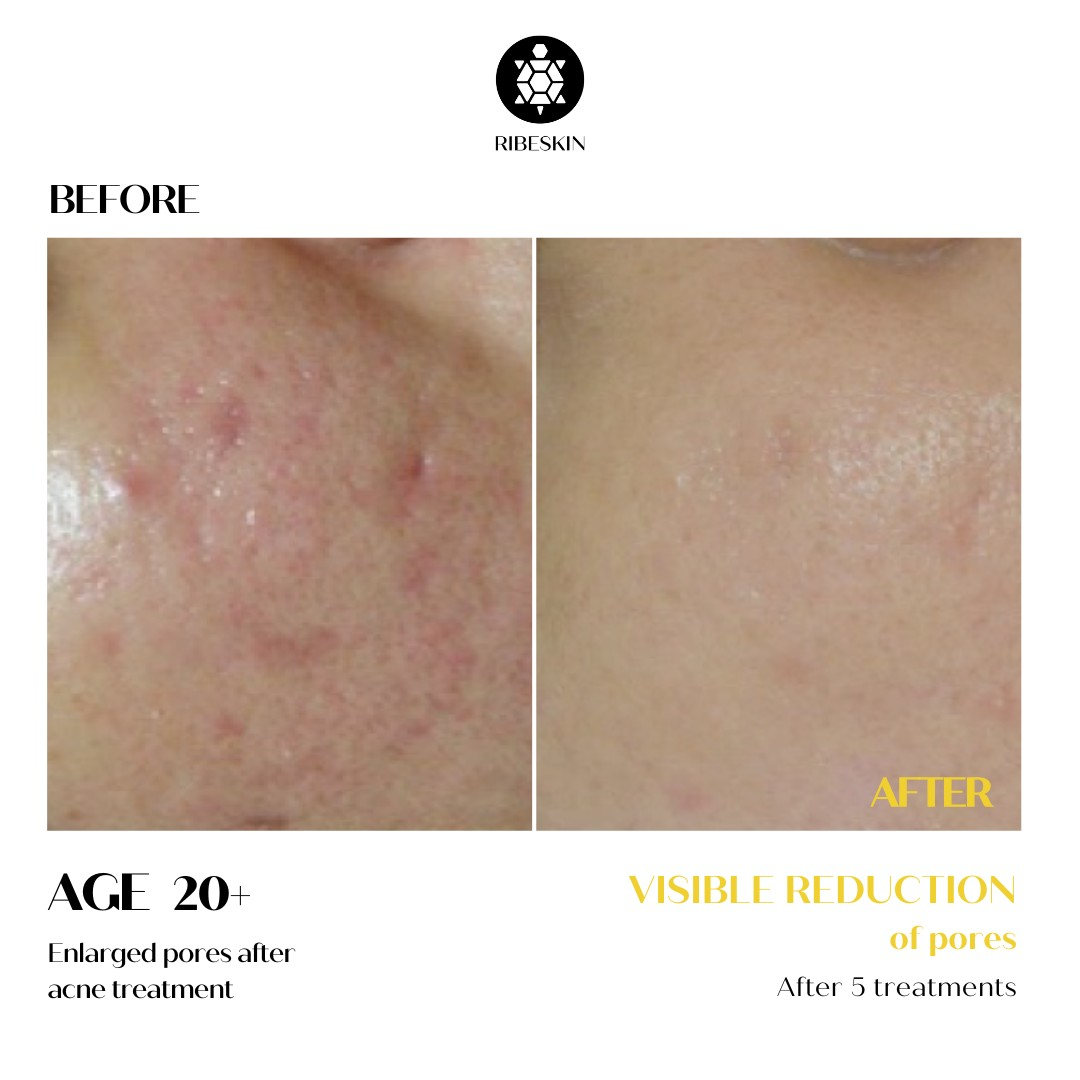 Before and after RIBESKIN G-PEEL ACDERM results after five treatments, showing visibly refined pores and smoother-looking skin texture.