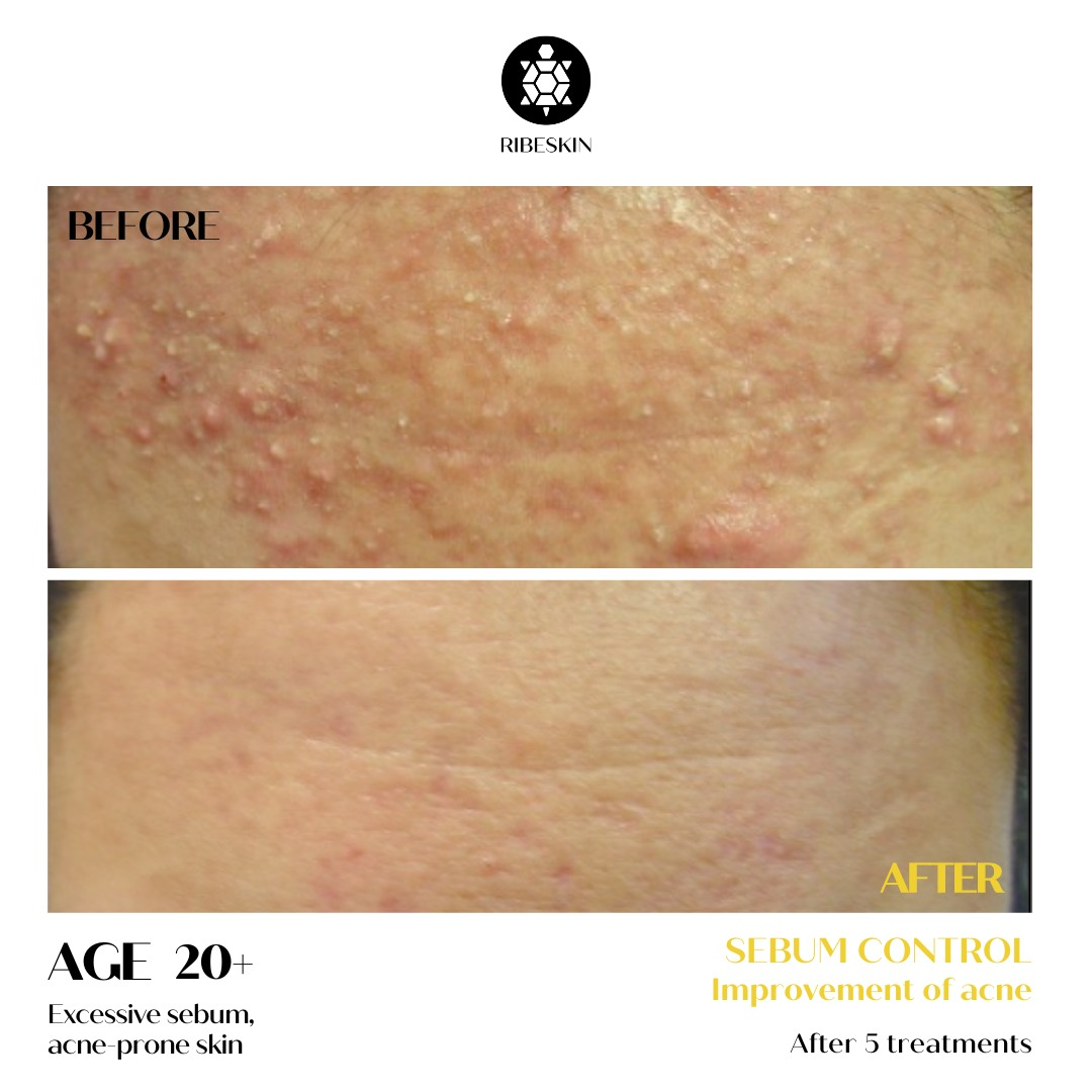 Before and after RIBESKIN G-PEEL ACDERM results after five treatments, showing a visible reduction in acne-related congestion and excess sebum.