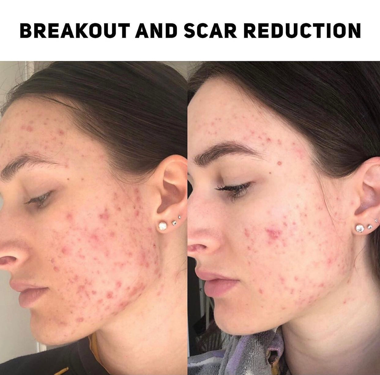 Young woman's face before and after breakout and scar reduction, showcased on Spa Circle Brands' product listing.