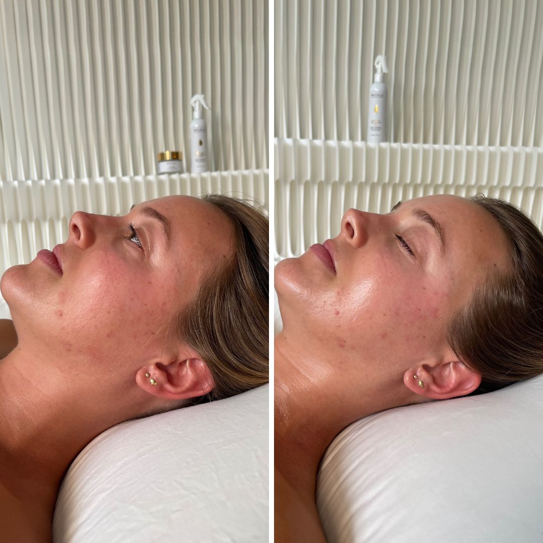 Before and after results of Spa Circle® Professional BIO-Lift Oxygen Peel & Treatment Fluid at Spa Circle, Brisbane QLD, showing improved skin radiance, hydration, and a smoother complexion. @myspacircle