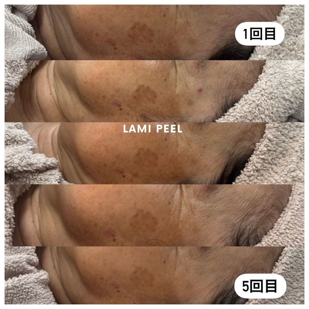 Before and after results of the DM Cell Skin Plus Japanese Lamination Peel (LAMI Peel) with CARBOXY and esthemax Hydrojelly and LED at Spa Circle, Brisbane, QLD. Visible improvements include smoother skin texture, reduced pigment age/sun spot. Image shows after 5 sessions. 