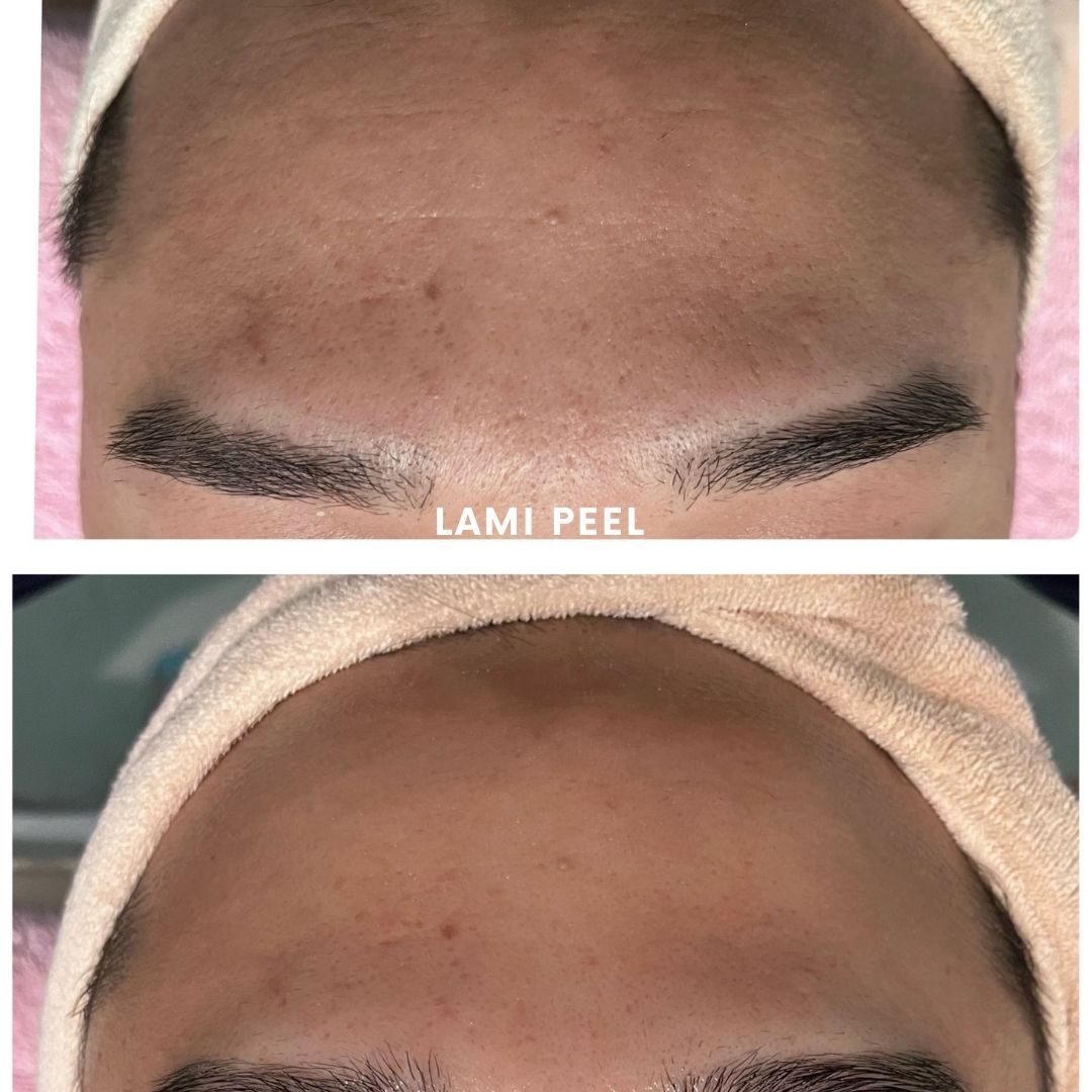 Before and after results of DM Cell Skin Plus Japanese Lamination Peel (LAMI Peel) at Spa Circle Brisbane, QLD, revealing refined skin texture, reduced forehead fine lines, and enhanced skin brightness.