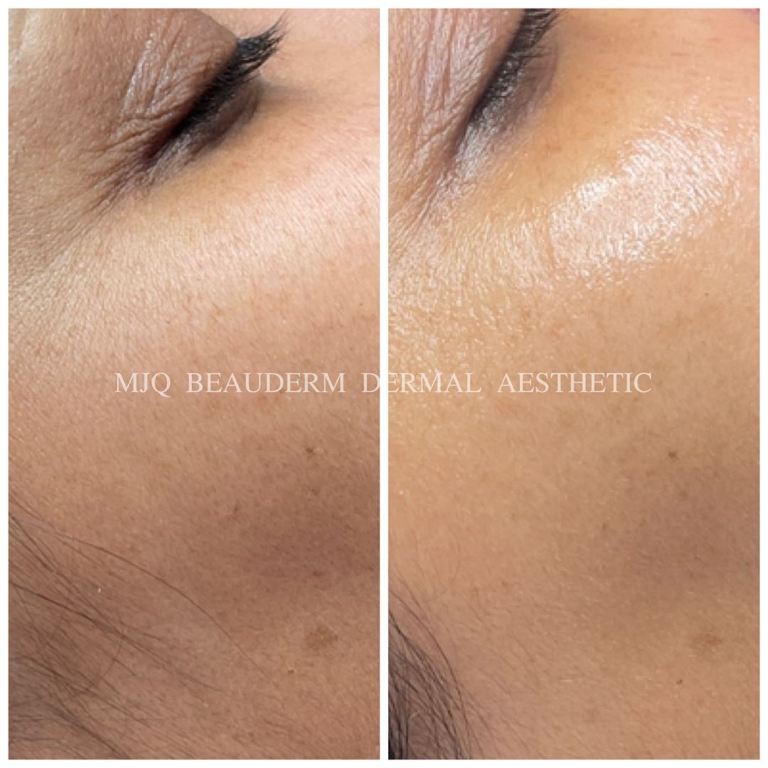 Before and after results of DM Cell Skin Plus Japanese Lamination Peel (LAMI Peel) at MJQ Beauderm Dermal Aesthetic Burnside, VIC, revealing refined skin texture, reduced fine lines, and enhanced skin brightness. @mjqbeaudermdermalaesthetic