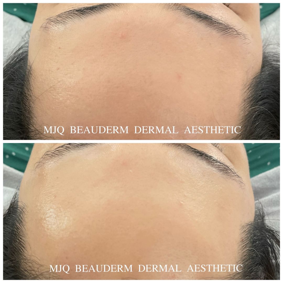 Before and after results of DM Cell Skin Plus Japanese Lamination Peel (LAMI Peel) at MJQ Beauderm Dermal Aesthetic Burnside, VIC, revealing refined skin texture, reduced fine lines, and enhanced skin brightness. @mjqbeaudermdermalaesthetic