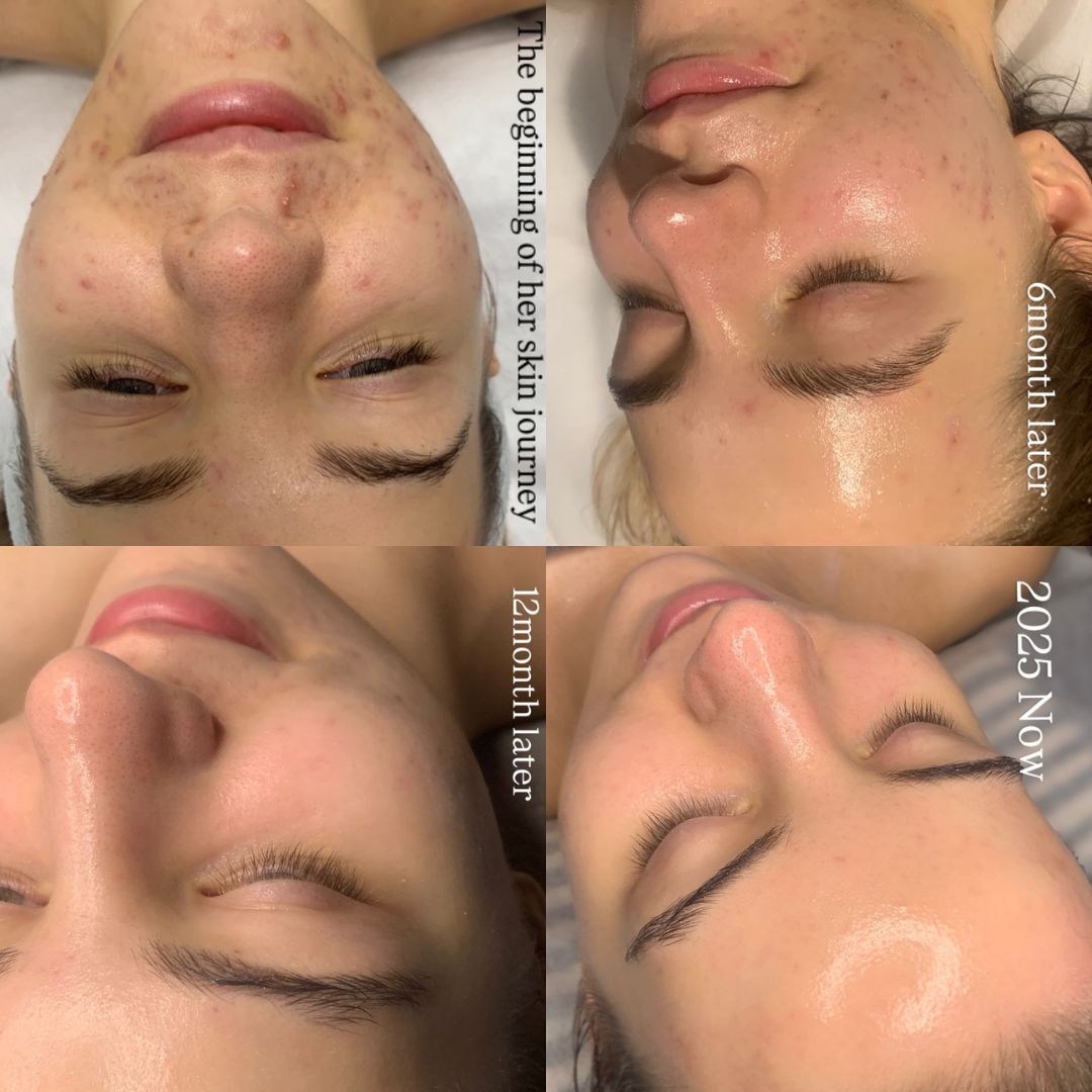 Before and after results of the DM Cell Skin Plus Japanese Lamination (LAMI) Peel at Tomoko Beauti, Sydney, NSW. Skin appears smoother, brighter, and more rejuvenated after treatment.