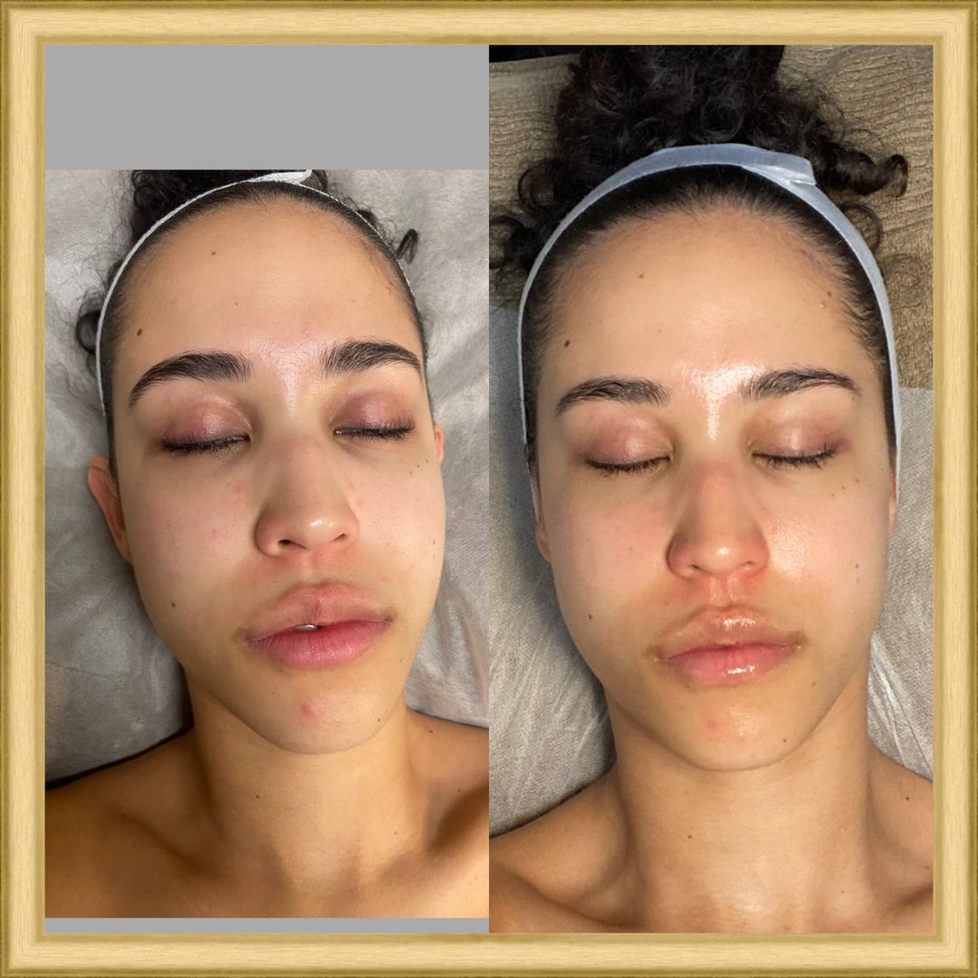 Before and after results after the DM Cell Skin Plus Japanese Lamination Peel (LAMI Peel) at In2skin Beauty and Dermal Therapy Melbourne, VIC, revealing lifted appearance, refined skin texture, reduced redness inflammation and enhanced hydration.