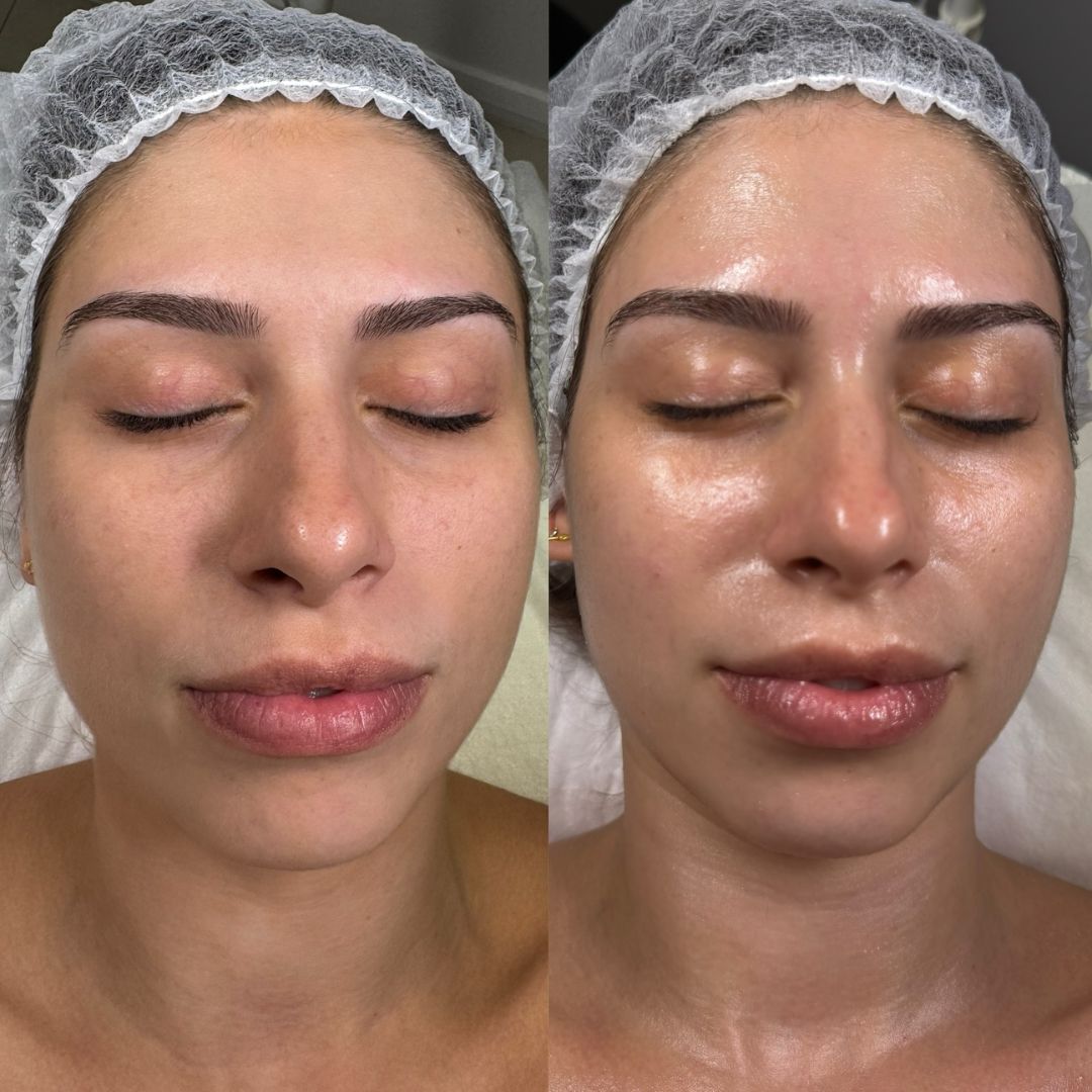 Before and after results of the Spa Circle® Professional esthemax® Argireline Contouring Mask at Exquise Skin Boutique, Harrington Park, NSW. Skin appears firmer, smoother, and more lifted after treatment. @exquise_skin_boutique