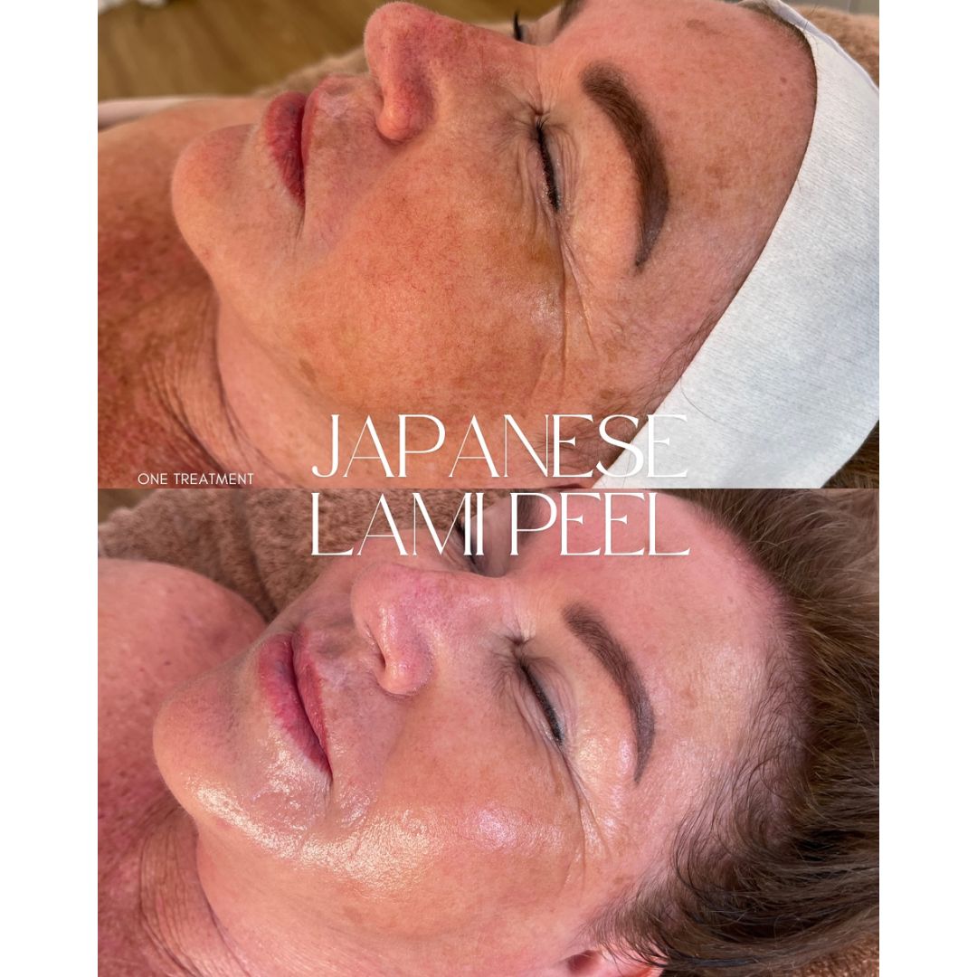 Before and after results of the DM Cell Skin Plus Japanese Lamination Peel (LAMI Peel) at Craft Skin Co., New Lambton, NSW. Skin appears visibly smoother, more hydrated, and rejuvenated after one treatment. @craftskinco
