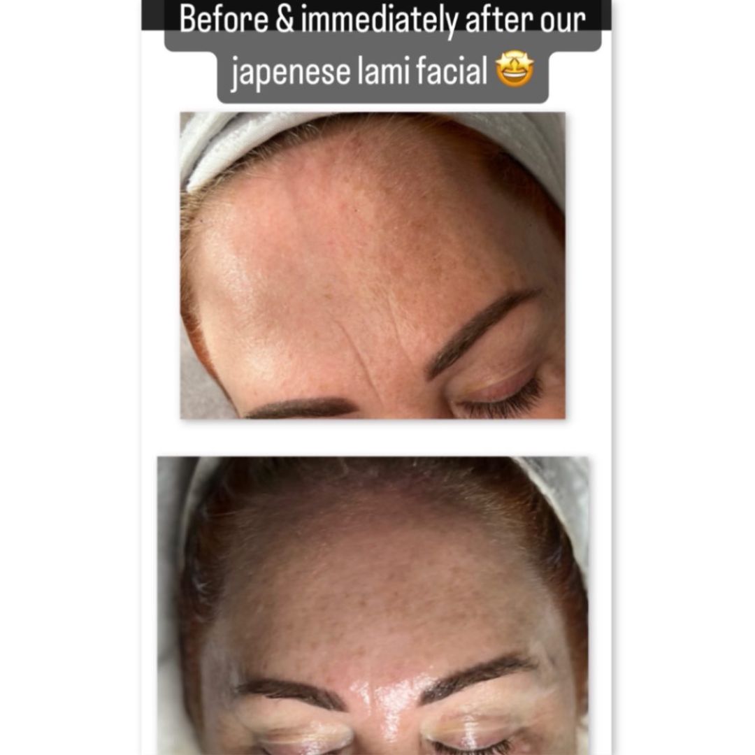 Before and after results after 1 session of the DM Cell Skin Plus Japanese Lamination Peel (LAMI Peel) at Skin by Sculpted Mooloolaba, QLD, revealing refined skin texture, reduced fine lines, and enhanced skin brightness. @skinbysculpted