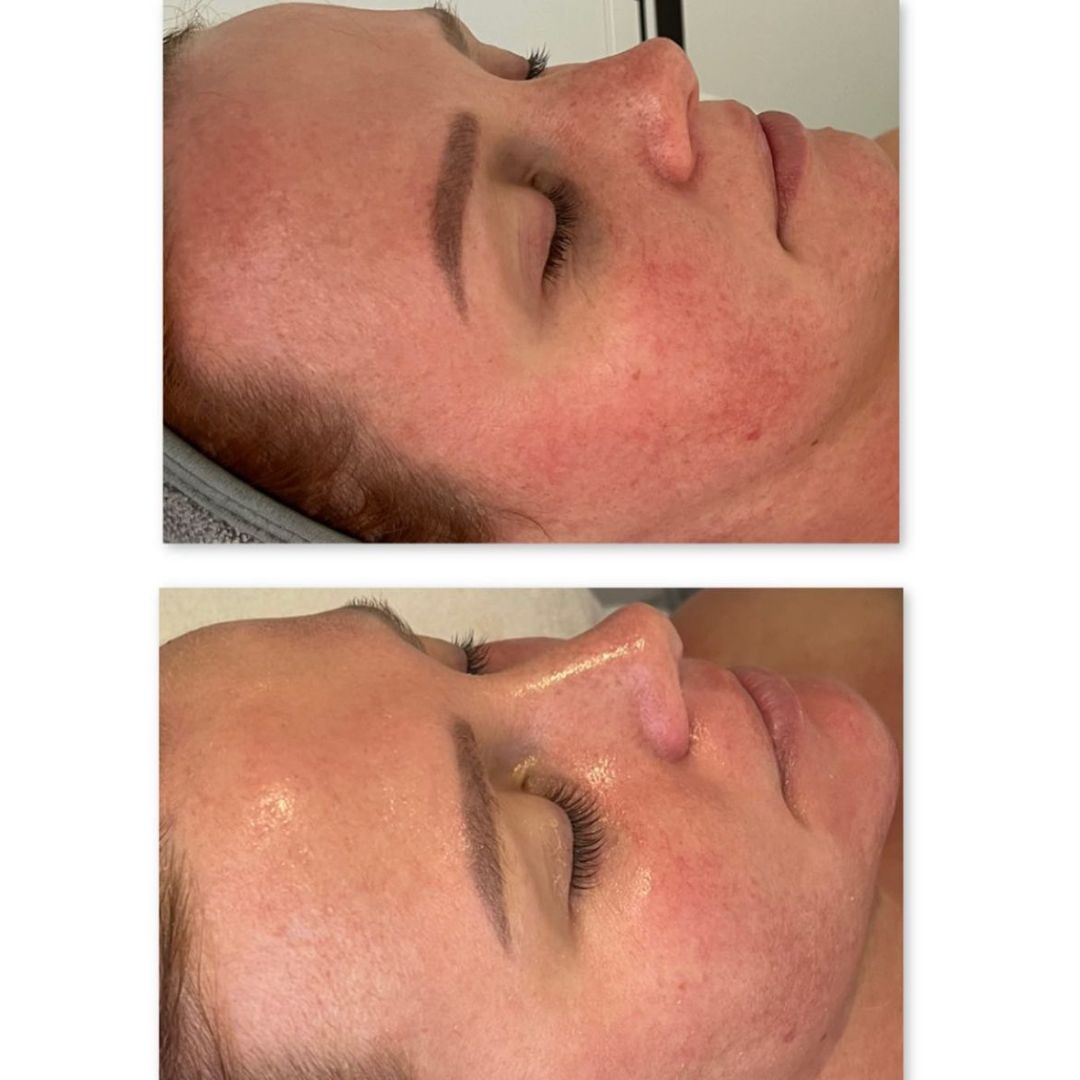 Before and after results after the DM Cell Skin Plus Japanese Lamination Peel (LAMI Peel) at Skin by Sculpted Mooloolaba, QLD, revealing refined skin texture, reduced fine lines, lifted appearance and enhanced skin brightness. @skinbysculpted