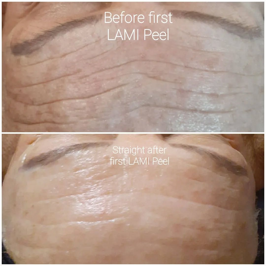 Before and after results after the DM Cell Skin Plus Japanese Lamination Peel (LAMI Peel) at Versailles Beauty Skin Care Clinic Redbank Plains,QLD, revealing refined skin texture, reduced forehead fine lines, lifted appearance and enhanced skin brightness. @versaillesbeautyclinic