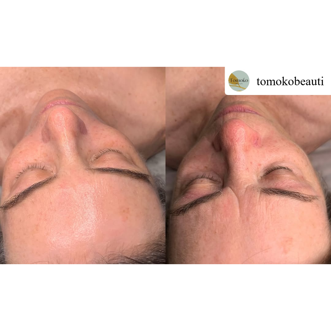 Before and after results of DM Cell Skin Plus Japanese Lamination Peel (LAMI Peel), esthemax Argireline Contouring Mask (Lymphatic Mask) at Tomoko Beauti, Sydney, Burwood, NSW showing improved hydration, revealing refined skin texture, reduced forehead fine lines, lifted appearance and enhanced skin brightness. @tomokobeauti