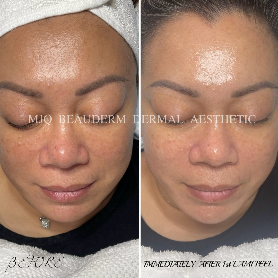 Before and after results of DM Cell Skin Plus Japanese Lamination Peel (LAMI Peel) at MJQ Beauderm Dermal Aesthetic Burnside, VIC, revealing refined skin texture, reduced fine lines, and enhanced skin brightness. @mjqbeaudermdermalaesthetic