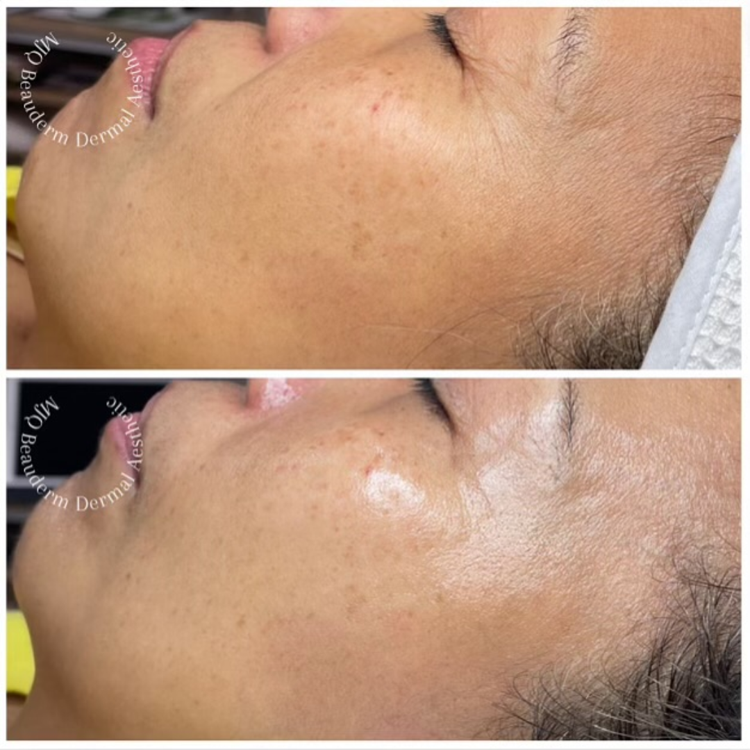 Before and after results of DM Cell Skin Plus Japanese Lamination Peel (LAMI Peel) at MJQ Beauderm Dermal Aesthetic Burnside, VIC, revealing refined skin texture, reduced fine lines, and enhanced skin brightness. @mjqbeaudermdermalaesthetic