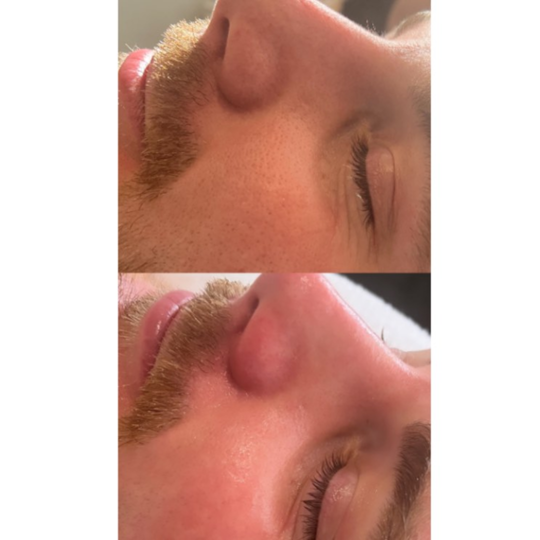 Before and after results of DM Cell Skin Plus Japanese Lamination Peel (LAMI Peel) at Skin By Sculpted Mooloolaba, QLD @skinbysculpted showing clean, tighter pores, improved hydration, refined skin texture and even tone. 