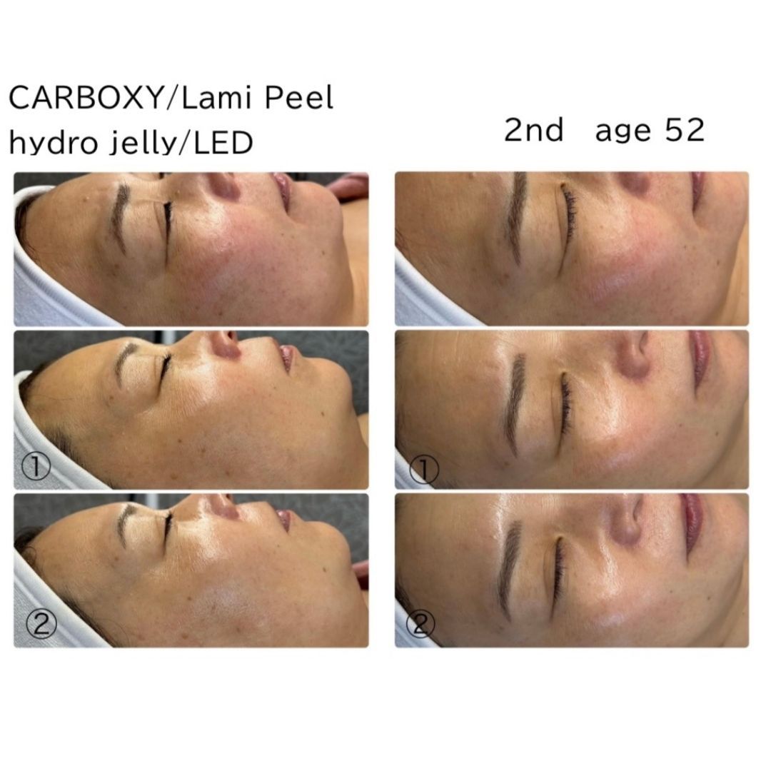 Before and after results of the DM Cell Skin Plus Japanese Lamination Peel (LAMI Peel) with CARBOXY and esthemax Hydrojelly and LED at Spa Circle, Brisbane, QLD. Visible improvements include smoother skin texture, reduced fine lines, and enhanced brightness.
