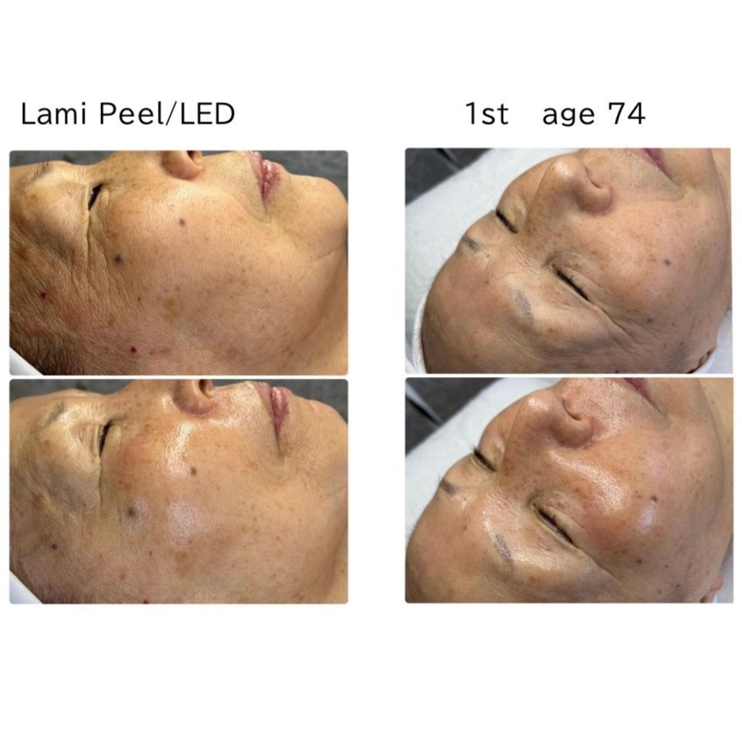 Before and after results of DM Cell Skin Plus Japanese Lamination Peel (LAMI Peel) with LED at Spa Circle Brisbane, QLD, mature client revealing refined skin texture, reduced fine lines, and enhanced skin brightness.