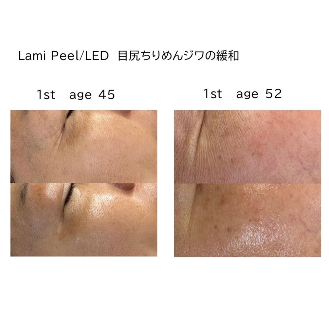 Before and after results of DM Cell Skin Plus Japanese Lamination Peel (LAMI Peel) at Spa Circle Brisbane, QLD, revealing refined skin texture, reduced fine lines around eyes, and enhanced skin brightness.