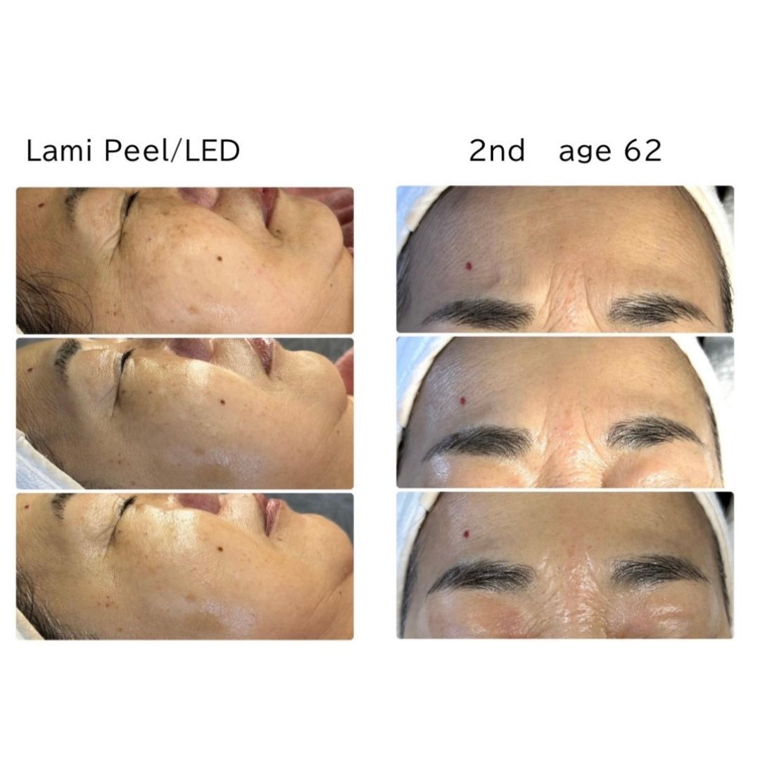 Before and after results of DM Cell Skin Plus Japanese Lamination Peel (LAMI Peel) at Spa Circle Brisbane, QLD, revealing refined skin texture, reduced fine lines, frown lines, and enhanced skin brightness.