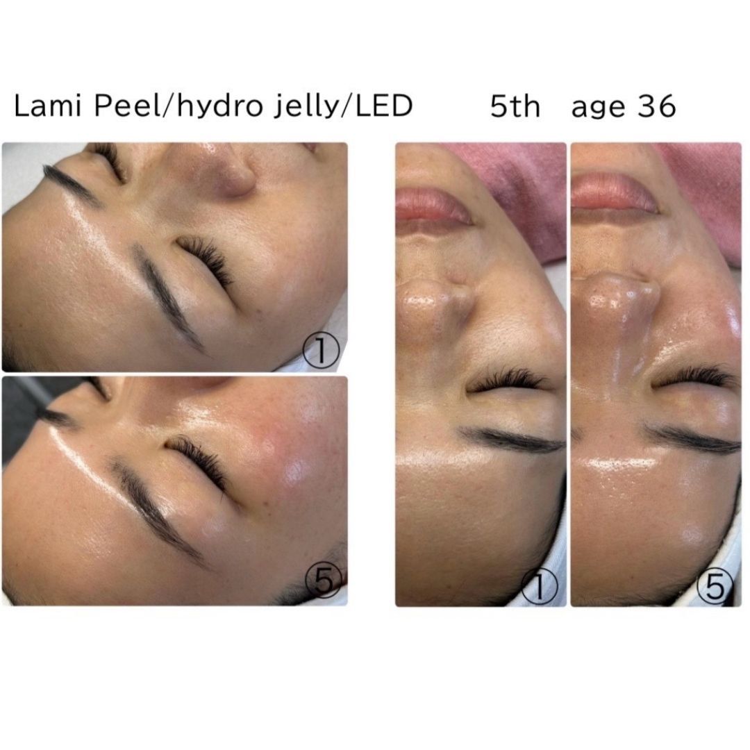 Before and after results of the DM Cell Skin Plus Japanese Lamination Peel (LAMI Peel) at Spa Circle, Brisbane, QLD. Visible improvements include smoother skin texture, reduced fine lines, enhanced brightness and hydration.