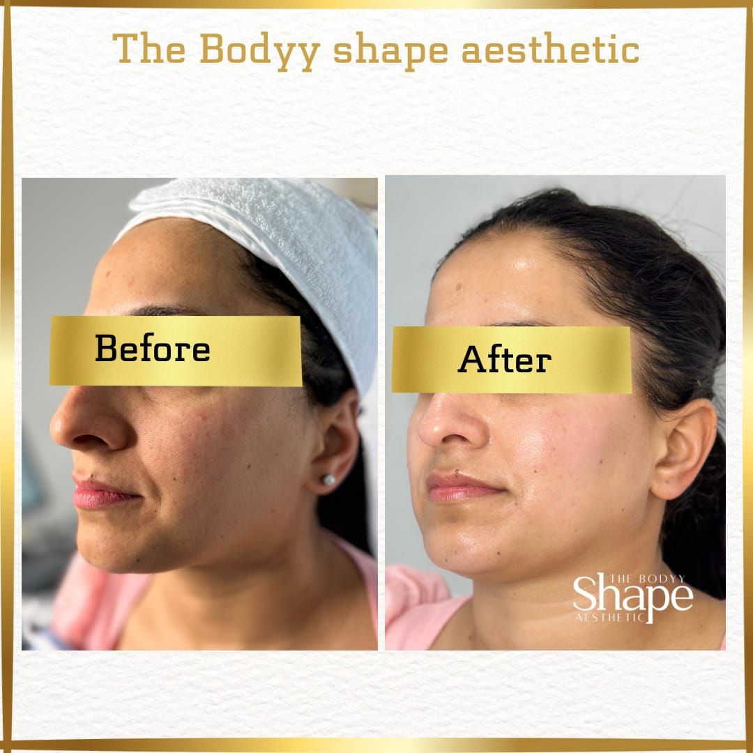 Before and after results after the Spa Circle® Professional Skin Perfecting Mandelic Peel at the The Bodyy Shape Aesthetic Tingalpa, QLD, revealing refined skin texture, reduced fine lines, lifted appearance and enhanced skin brightness. 
