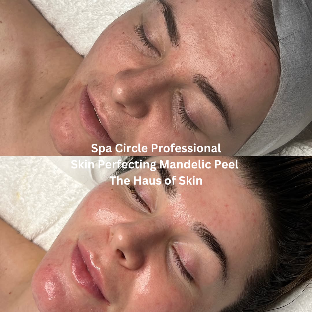 Before and after images following a Spa Circle Professional Skin Perfecting Mandelic Peel at The Haus of Skin. The after image shows clearer-looking skin with improved radiance, reduced congestion, and a more even, luminous finish.