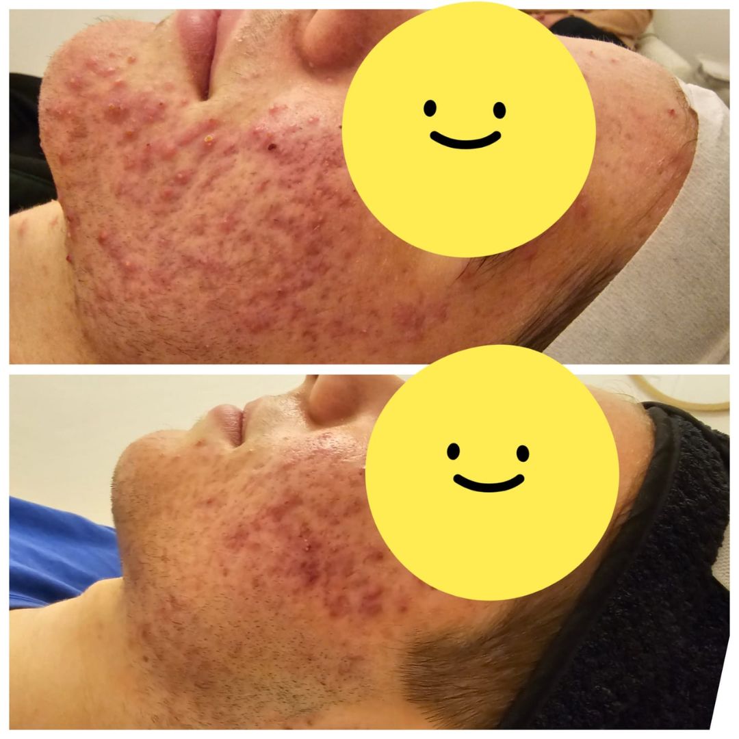 Before and after results after at-home homecare use of the emerginC Deglazing Cleanser at Showstopper Brows Kingsley, WA, revealing reduced active acne breakouts.