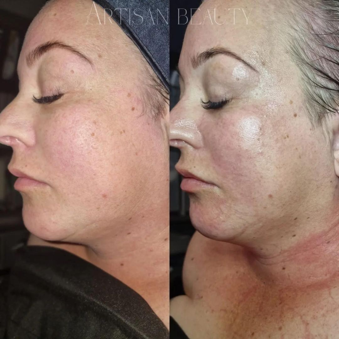 Before and after results after the esthemax Argireline Contouring Mask at Artisan Beauty Skin Massage Brisbane, QLD, revealing lifted, firmed skin with improved texture. @artisanbeautyskinmassage