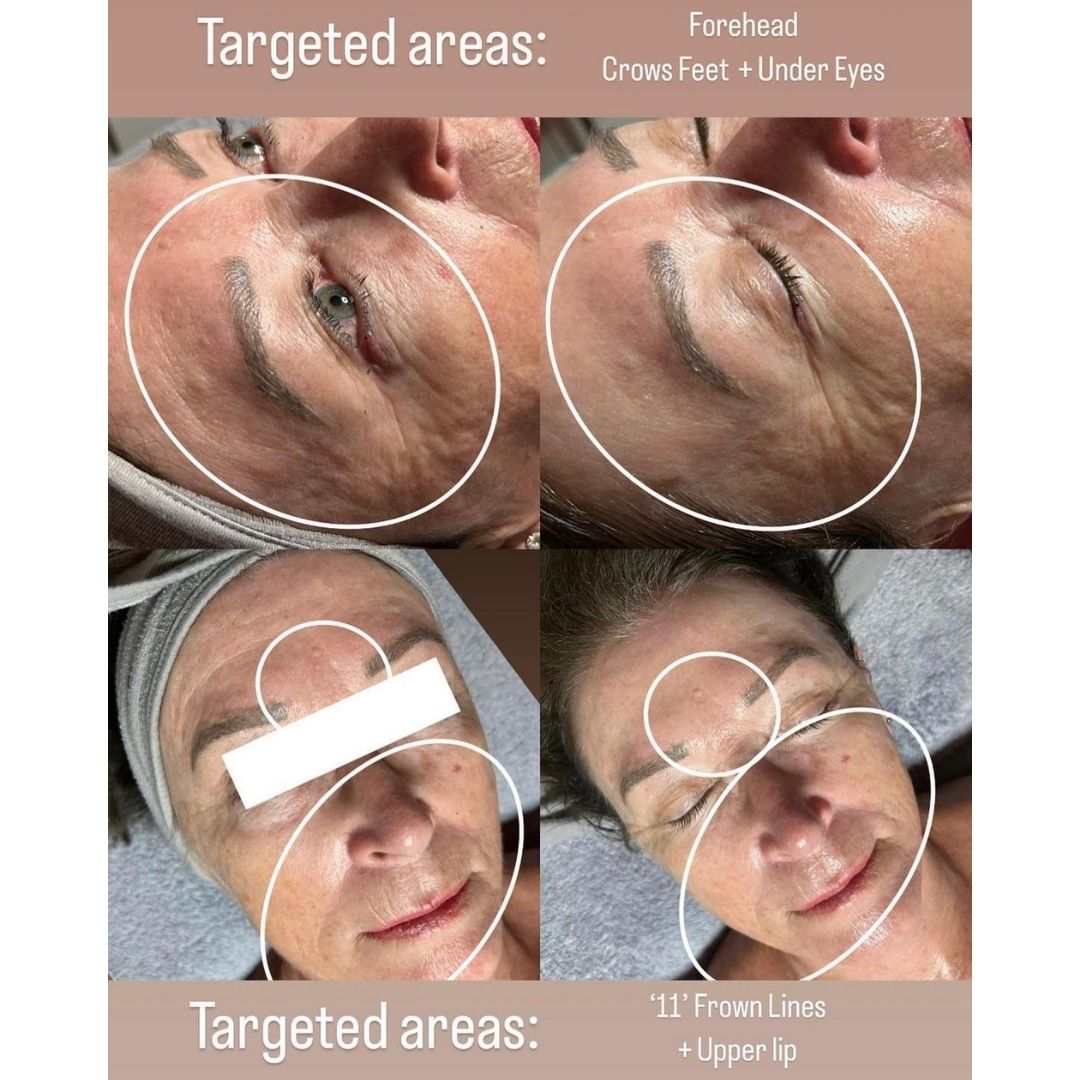 Before and after results after the esthemax Argireline Contouring Mask at Beauty House, Melbourne, VIC, revealing firmer skin, refined pores, and an even complexion. @beautyhouse_melb