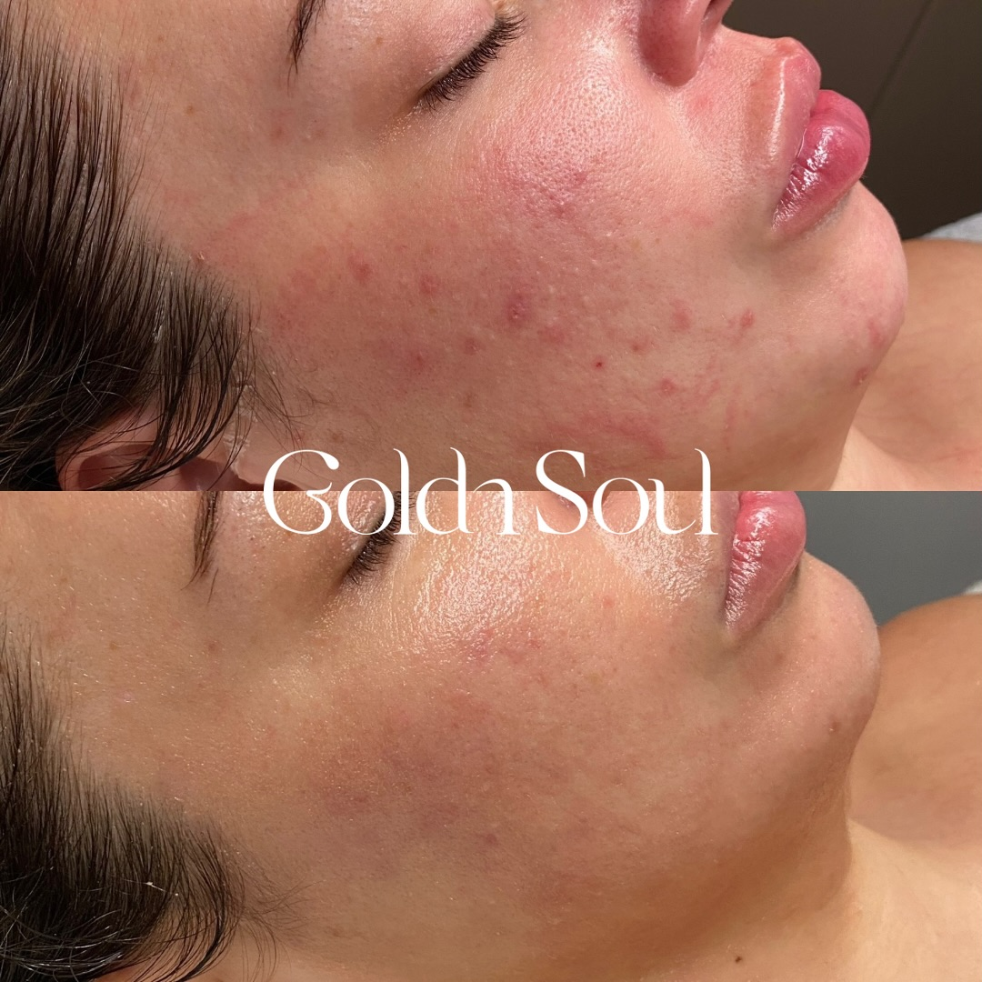 Before and after results after the esthemax Argireline Contouring Mask (Lymphatic Mask) at Goldn Soul Aesthetics, Long Jetty, NSW, 1 month between sessions, revealing refined skin texture, reduced fine lines, and even tone. @_goldnsoul