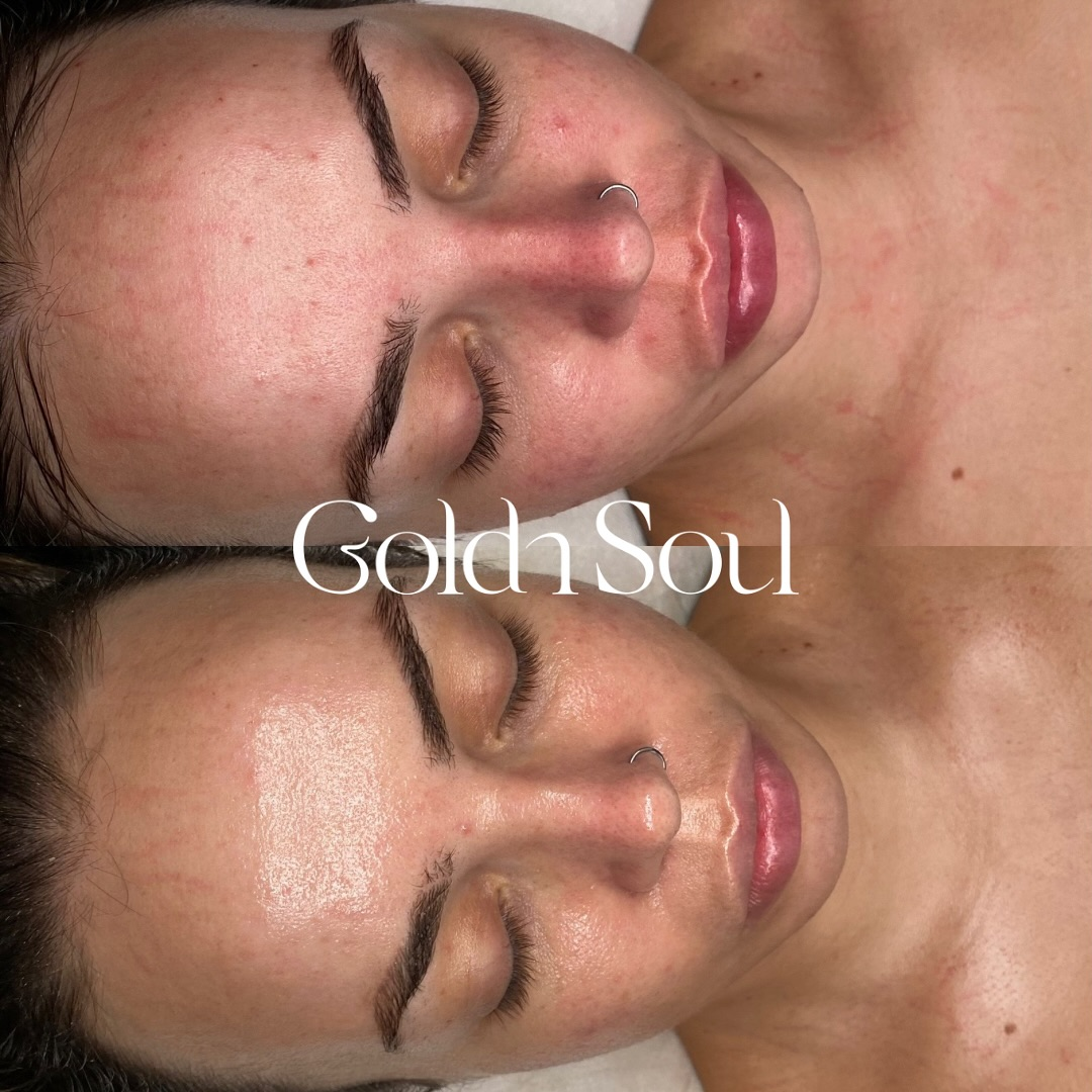 Before and after results after the esthemax Argireline Contouring Mask (Lymphatic Mask) at Goldn Soul Aesthetics, Long Jetty, NSW, 1 month between sessions, revealing refined skin texture, reduced fine lines, and even tone. @_goldnsoul