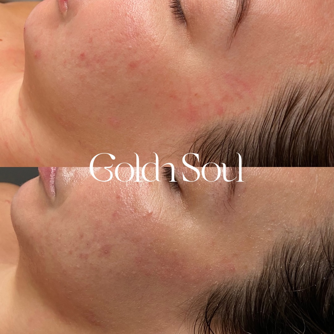 Before and after results after the esthemax Argireline Contouring Mask (Lymphatic Mask) at Goldn Soul Aesthetics, Long Jetty, NSW, 1 month between sessions, revealing refined skin texture, reduced fine lines, and even tone. @_goldnsoul