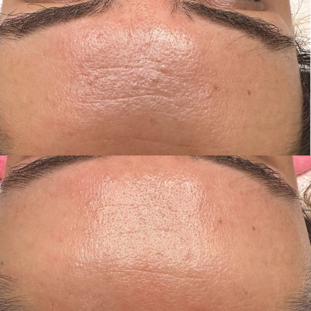 Before and after results of the Japanese Lamination Facial using the DM Cell Skin Plus TRADE LAMI PEEL Kit at Exquise Skin Boutique, Harrington Park, NSW. Skin appears smoother, reduced fine lines, and more refined. @exquise_skin_boutique