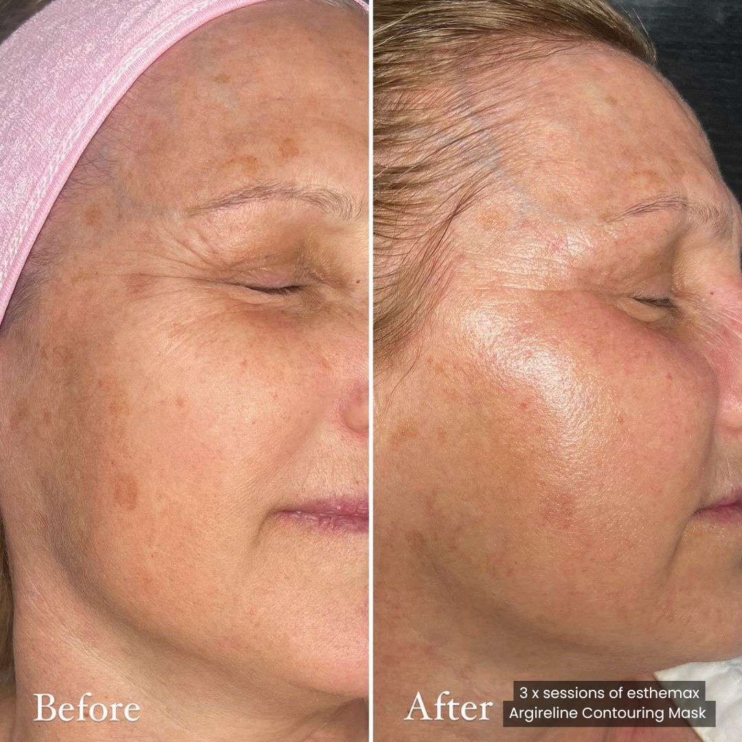 Before and after results after 3 sessions of esthemax Argireline Contouring Mask (Lymphatic Mask) at Allure Lounge Melbourne, VIC, revealing refined skin texture, reduced fine lines, and even tone. @allurelounge