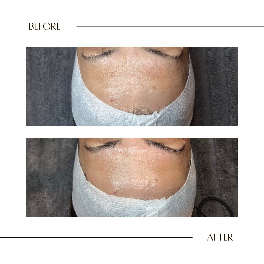 Before and after results after the esthemax Argireline Contouring Mask (Lymphatic Mask) at Bellissima Skin Boutique Ormond, VIC, revealing refined skin texture, reduced fine lines, and even tone. @bellissimaskinboutique 