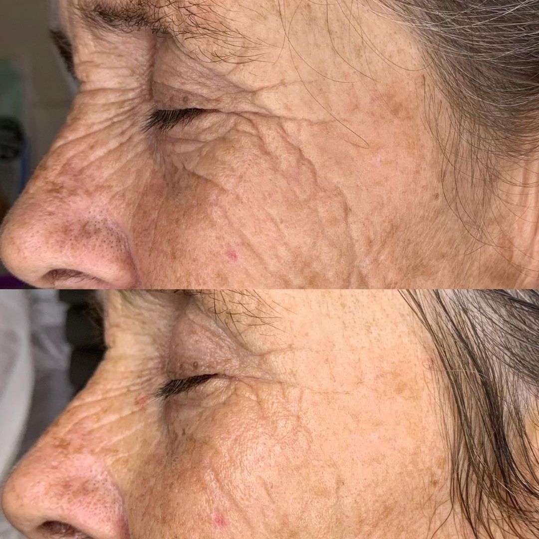Before and after results after the esthemax Argireline Contouring Mask at So Fetch Beauty Bathurst, NSW, revealing improved skin elasticity, sculpted facial contours, and a refreshed appearance. @so.fetch_beauty