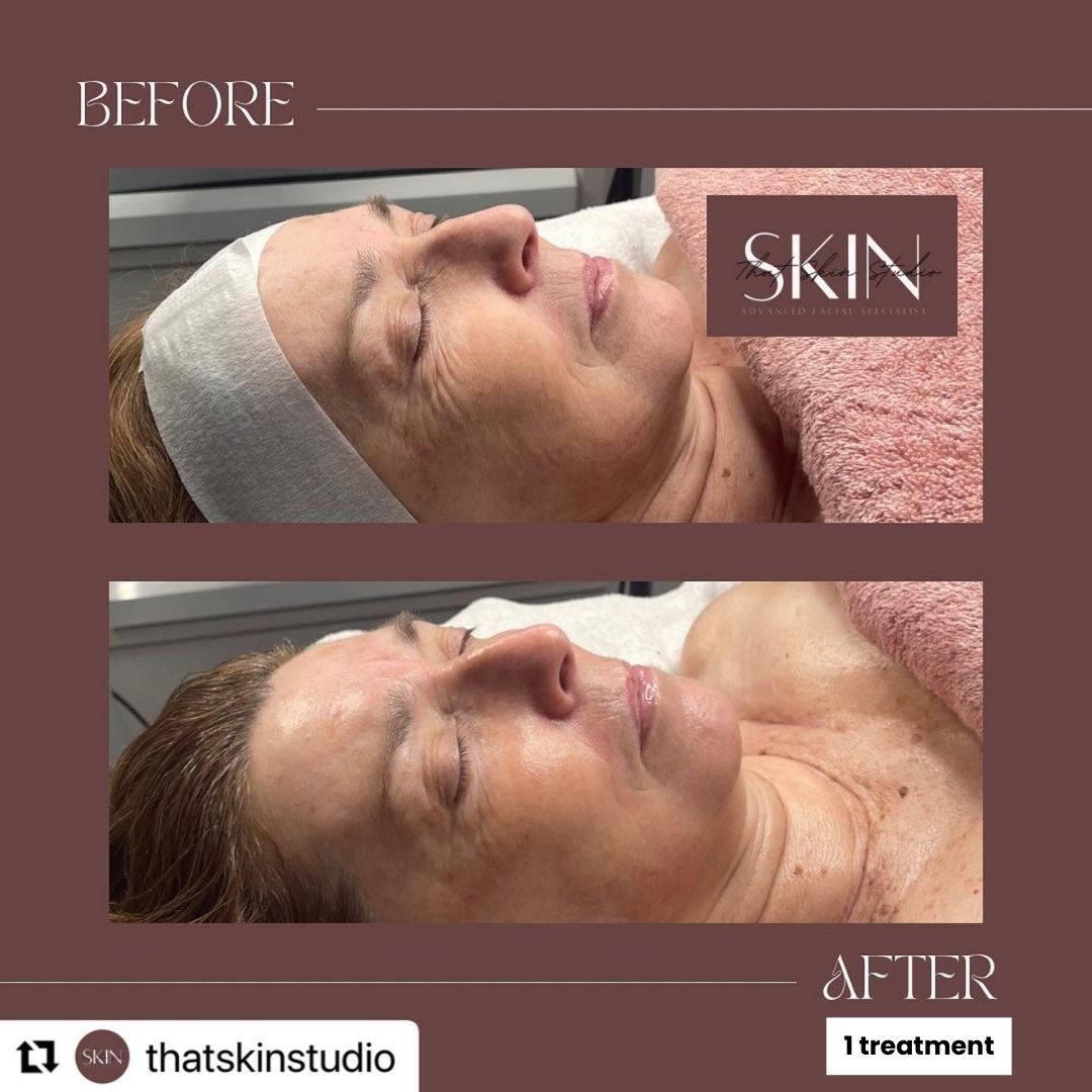 Before and after results after the esthemax Argireline Contouring Mask at That Skin Studio Adelaide, SA, revealing a lifted, firmed, and glowing complexion. @thatskinstudio