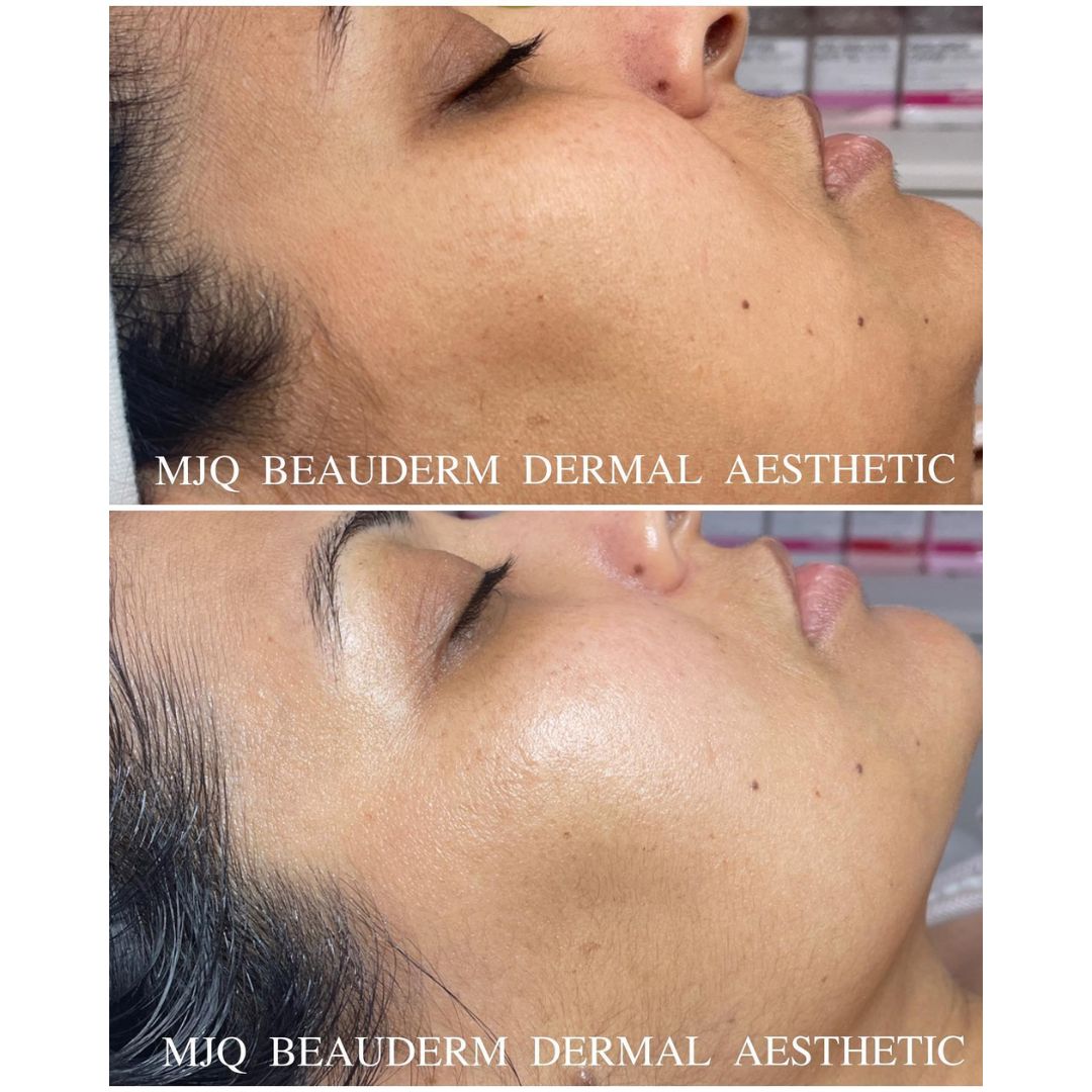 Before and after results after the esthemax Hydrojelly® Mask at MJQ Beauderm Dermal Aesthetic Burnside, VIC, revealing enhanced hydration, plumper skin, and a radiant glow. @mjqbeaudermdermalaesthetic