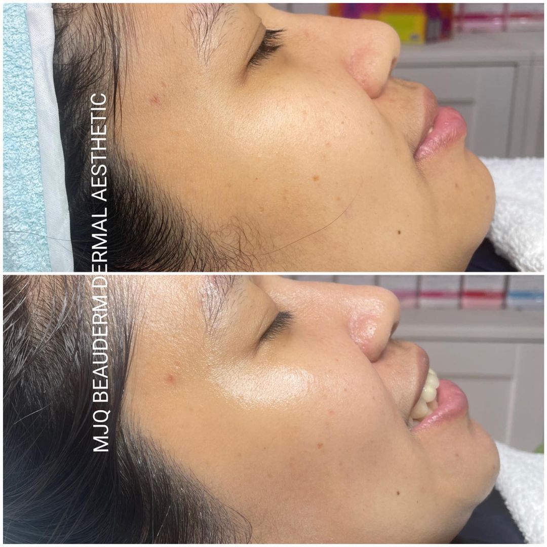 Before and after results after the esthemax Hydrojelly® Mask at MJQ Beauderm Dermal Aesthetic Burnside, VIC, revealing enhanced hydration, plumper skin, and a radiant glow. @mjqbeaudermdermalaesthetic