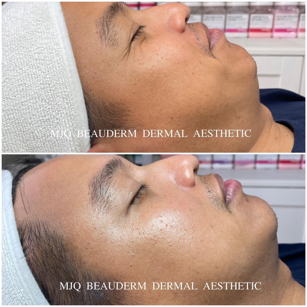 Before and after results after the esthemax Hydrojelly® Mask at MJQ Beauderm Dermal Aesthetic Burnside, VIC, revealing enhanced hydration, plumper skin, and a radiant glow. @mjqbeaudermdermalaesthetic