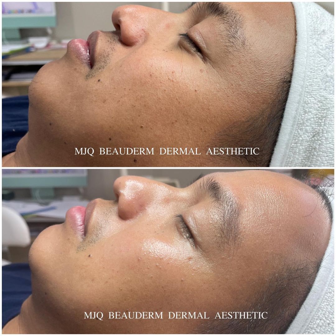 Before and after results after the esthemax Hydrojelly® Mask at MJQ Beauderm Dermal Aesthetic Burnside, VIC, revealing enhanced hydration, plumper skin, and a radiant glow. @mjqbeaudermdermalaesthetic