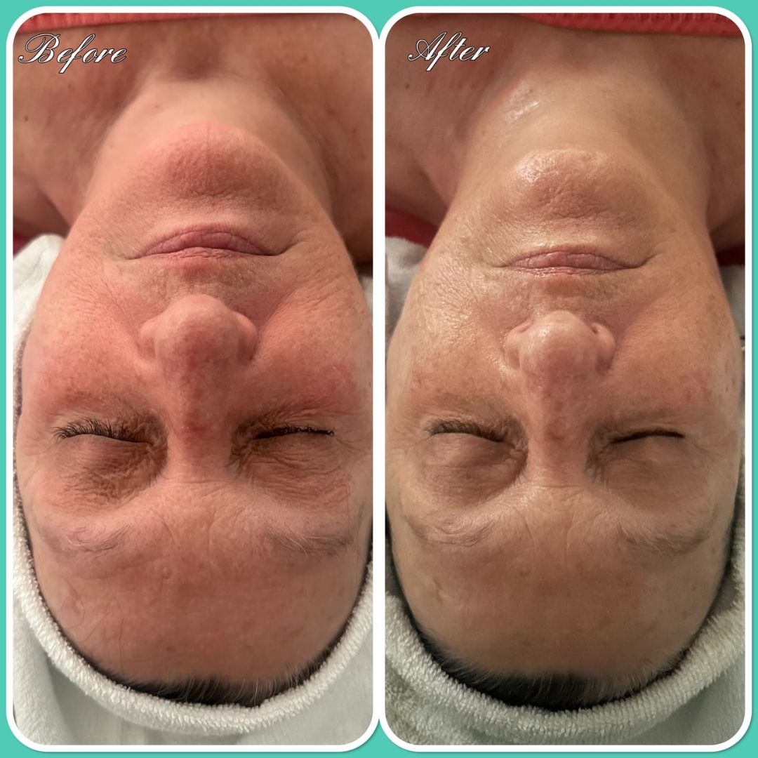 Before and after results after the esthemax Oxygen Cure Serum and Hydrojelly Mask at Island Beauty Hut Bribie, OLQ, revealing calmed red skin, reduced fine lines and enhanced hydration. 