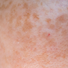 Pigmentation skin condition thumbnail featured on Spa Circle Brands Page.