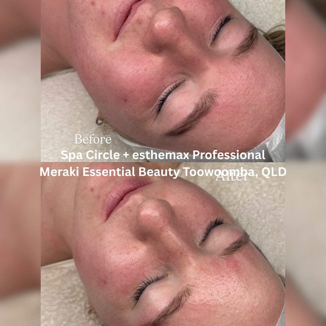 Before and after Spa Circle and esthemax Professional facial at Meraki Essential Beauty, Toowoomba QLD, showing brighter-looking skin, improved hydration and a fresh post-treatment glow.