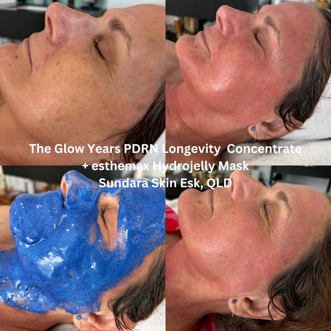 Treatment journey using The Glow Years PDRN Longevity Concentrate and esthemax Hydrojelly Mask, showing visibly brighter, hydrated skin with enhanced post-treatment glow.