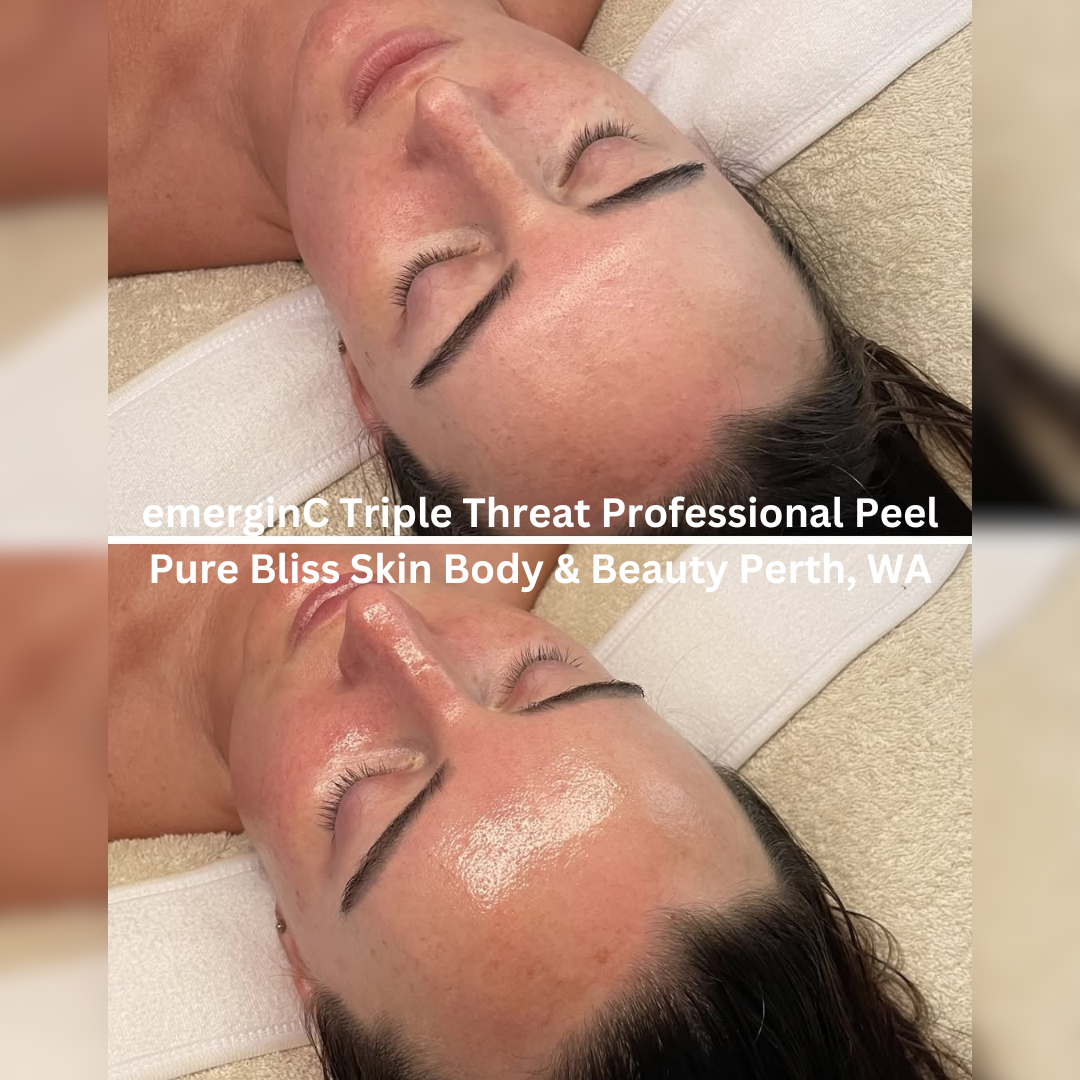 Before and after images of the face following an emerginC Triple Threat Professional Peel at Pure Bliss Skin Body & Beauty in Perth, Western Australia. The after image shows brighter, more luminous skin with enhanced glow, hydration, and overall skin clarity.