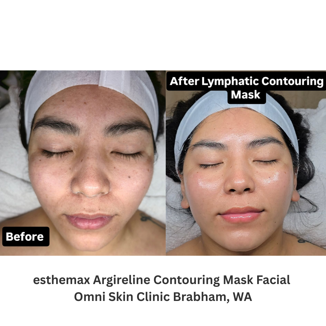 Before and after results of an esthemax® Argireline Contouring Mask Facial at Omni Skin Clinic in Brabham, Western Australia. The client’s skin appears visibly lifted and refined, with smoother texture and reduced puffiness after the lymphatic compression treatment.