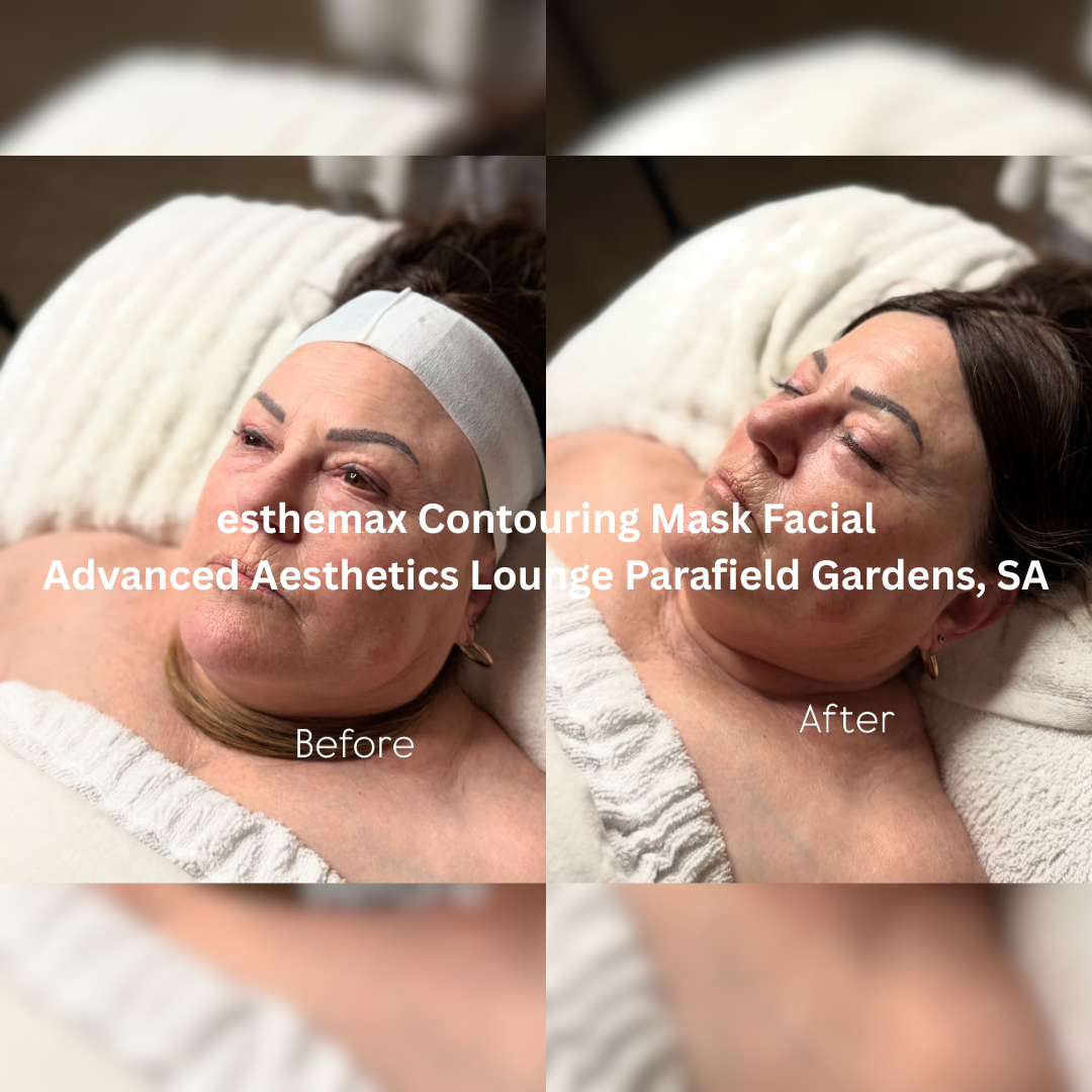 Before and after esthemax Contouring Mask Facial at Advanced Aesthetics Lounge, Parafield Gardens SA, showing a more lifted, refreshed appearance with smoother-looking skin and enhanced radiance.