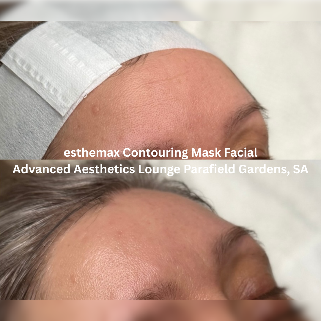 Before and after esthemax Contouring Mask Facial, showing smoother-looking forehead texture, softened fine lines and a more hydrated, luminous finish.